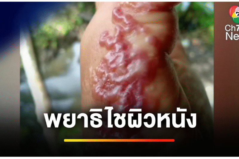 ขนลุก ! พยาธิไชผิวหนัง หลังไปถอนหญ้ามาทั้งวัน | ข่าวเย็นประเด็นร้อน